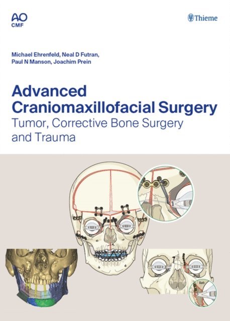 Joachim Prein, Paul Manson, Neal D. Futran, Michael Ehrenfeld - Advanced Craniomaxillofacial Surgery, E-bok