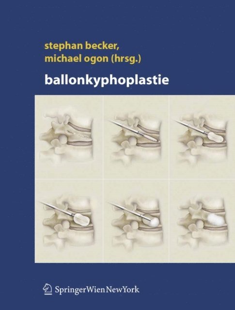 Michael Ogon, Stephan Becker - Ballonkyphoplastie, E-bok