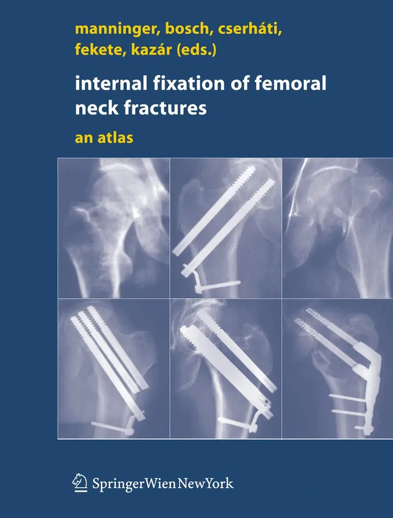 Jenó Manninger, Ulrich Bosch, Peter Cserháti, Károly Fekete, György Kazár - Internal fixation of femoral neck fractures, Inbunden. Tillgänglighet: Lägg i varukorg