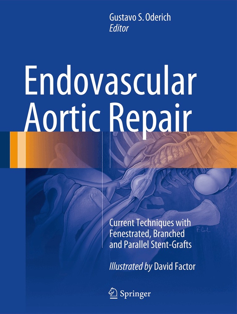 Gustavo S. Oderich - Endovascular Aortic Repair, Inbunden. Tillgänglighet: Lägg i varukorg