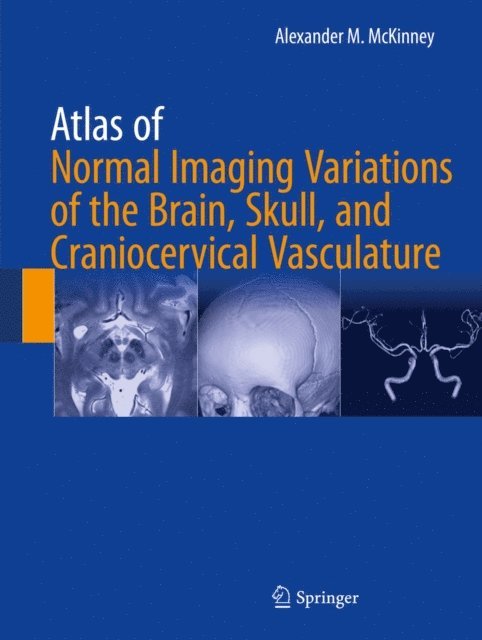 Alexander M. McKinney - Atlas of Normal Imaging Variations of the Brain, Skull, and Craniocervical Vasculature, E-bok