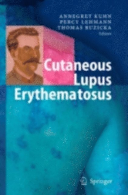 Thomas Ruzicka, Percy Mario Lehmann, Annegret Kuhn - Cutaneous Lupus Erythematosus, E-bok