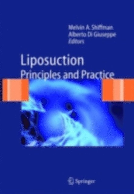 Alberto Di Giuseppe, Melvin A. Shiffman - Liposuction, E-bok