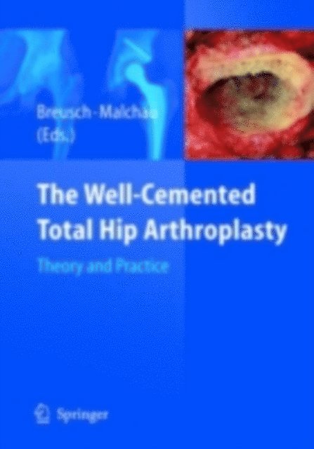 Henrik Malchau, Steffen Breusch - Well-Cemented Total Hip Arthroplasty, E-bok