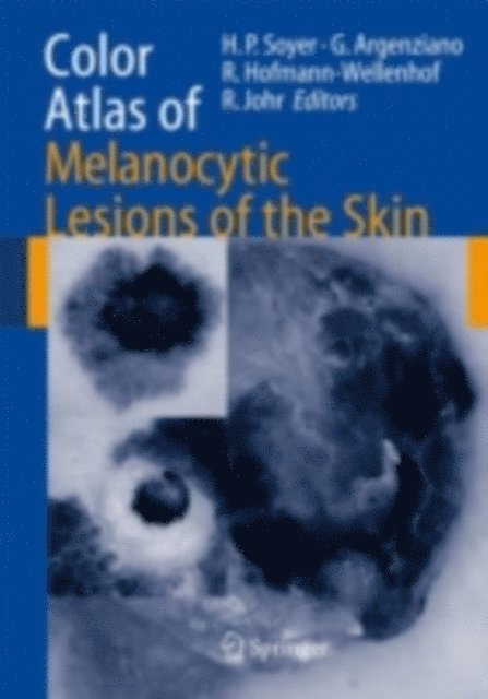 Robert H. Johr, Rainer Hofmann-Wellenhof, giuseppe argenziano, H. Peter Soyer - Color Atlas of Melanocytic Lesions of the Skin, E-bok