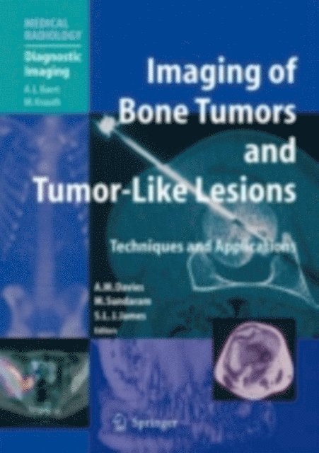 Steven J. James, Murali Sundaram, A. Mark Davies - Imaging of Bone Tumors and Tumor-Like Lesions, E-bok