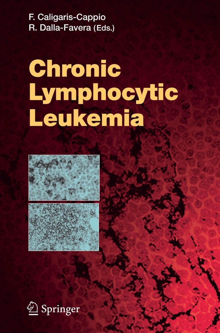 Chronic Lymphocytic Leukemia, Häftad