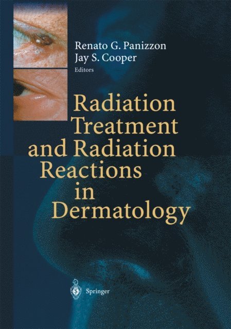Jay S. Cooper, Renato G. Panizzon - Radiation Treatment and Radiation Reactions in Dermatology, E-bok