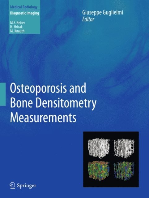 Giuseppe Guglielmi - Osteoporosis and Bone Densitometry Measurements, E-bok