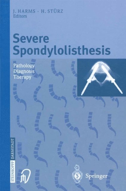 H. Sturz, J. Harms - Severe Spondylolisthesis, E-bok