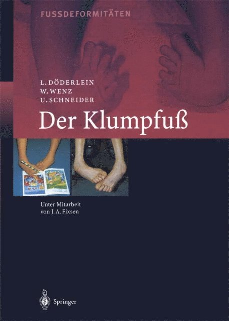 Urs Schneider, Wolfram Wenz, Leonhard Doderlein - Der Klumpfuss, E-bok