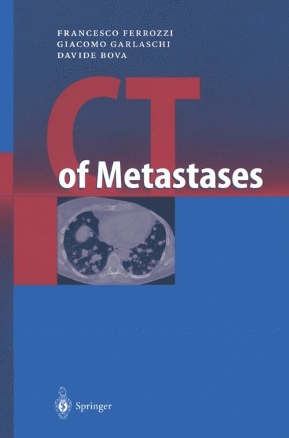 Davide Bova, Giacomo Garlaschi, Francesco Ferrozzi - CT of Metastases, E-bok