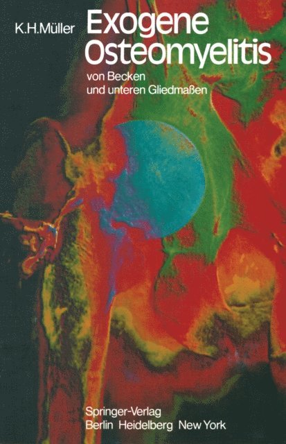 K.H. Muller - Exogene Osteomyelitis von Becken und unteren Gliedmaßen, E-bok