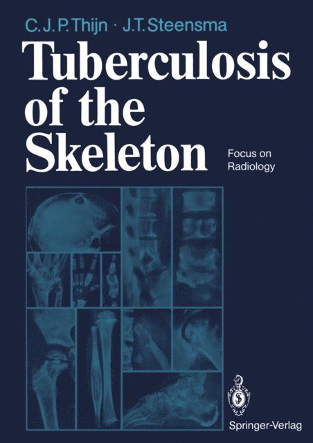 Jieldouw T. Steensma, Cornelis J.P. Thijn - Tuberculosis of the Skeleton, E-bok. Tillgänglighet: Lägg i varukorg