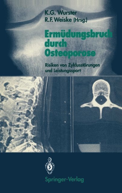 Roman F. Weiske, Kurt G. Wurster - Ermüdungsbruch durch Osteoporose, E-bok