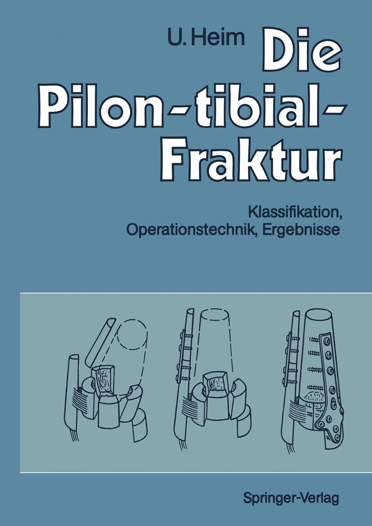 Urs Heim - Die Pilon-tibial-Fraktur, Häftad