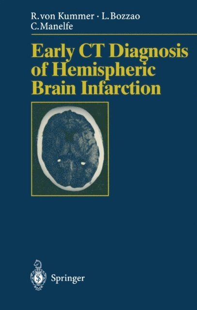 Claude Manelfe, Luigi Bozzao, Rudiger v. Kummer - Early CT Diagnosis of Hemispheric Brain Infarction, E-bok