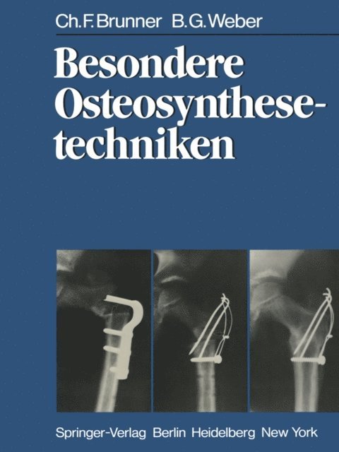 B. G. Weber, C. F. Brunner - Besondere Osteosynthesetechniken, E-bok