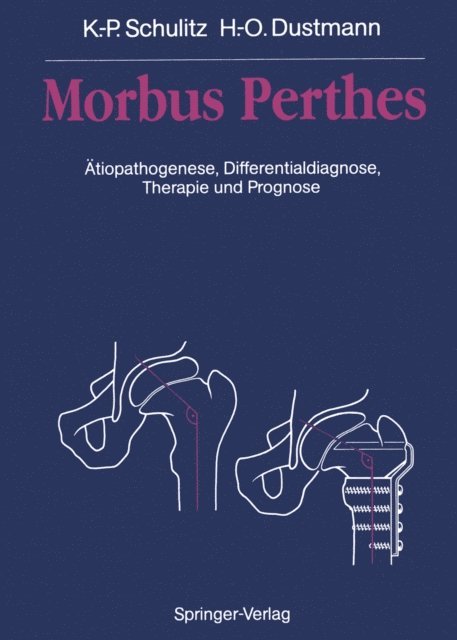 Hans-Otto Dustmann, Klaus-Peter Schulitz - Morbus Perthes, E-bok. Tillgänglighet: Lägg i varukorg