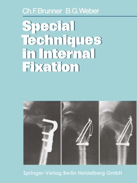 B. G. Weber, C. F. Brunner - Special Techniques in Internal Fixation, E-bok