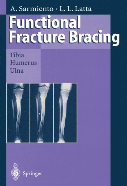 Loren L. Latta, Augusto Sarmiento - Functional Fracture Bracing, E-bok