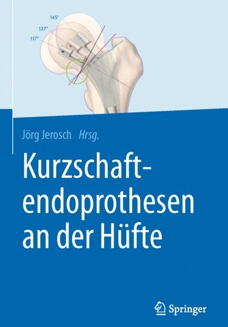 Jorg Jerosch - Kurzschaftendoprothesen an der Hüfte, E-bok