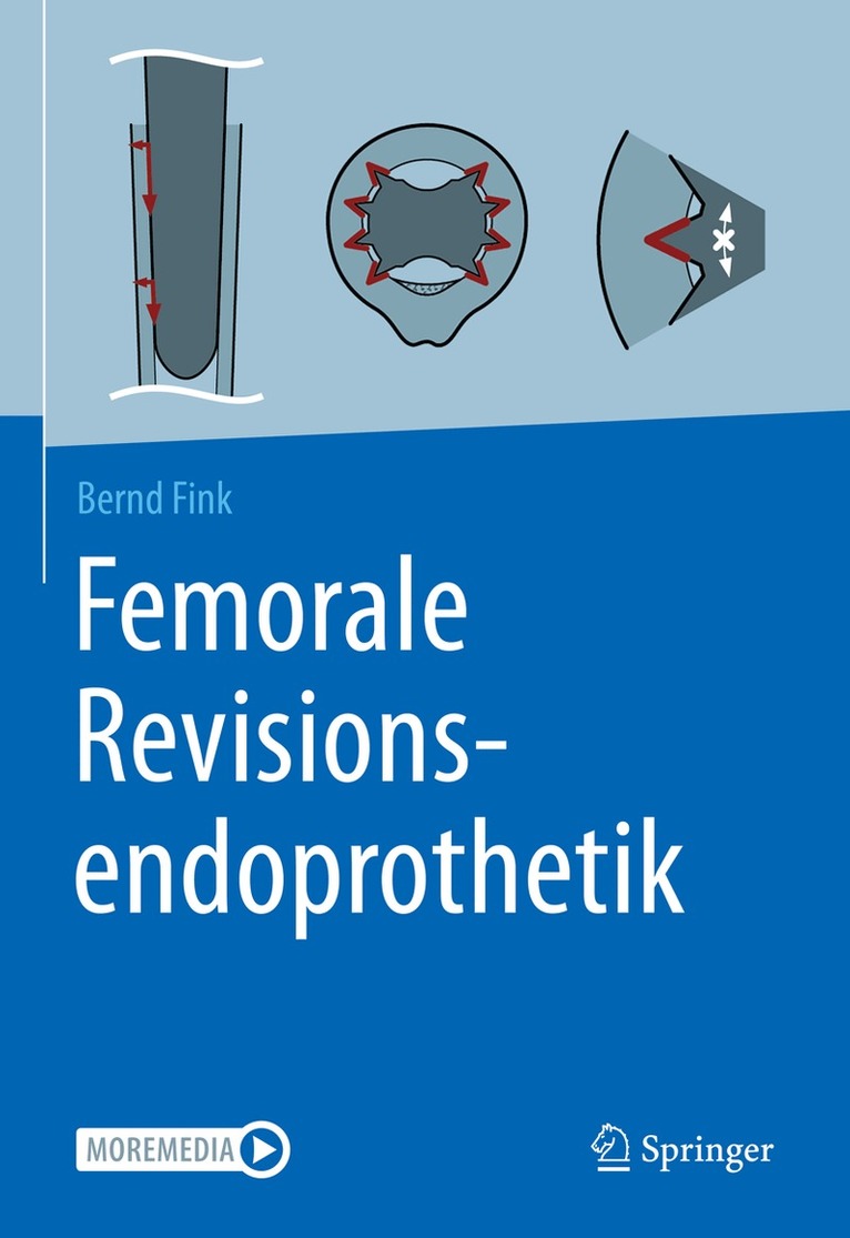 Bernd Fink - Femorale Revisionsendoprothetik, Inbunden. Tillgänglighet: Lägg i varukorg