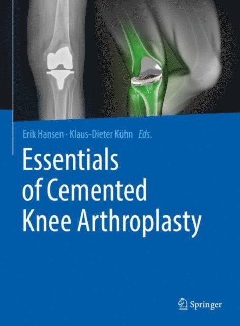 Klaus-Dieter Kuhn, Erik Hansen - Essentials of Cemented Knee Arthroplasty, E-bok