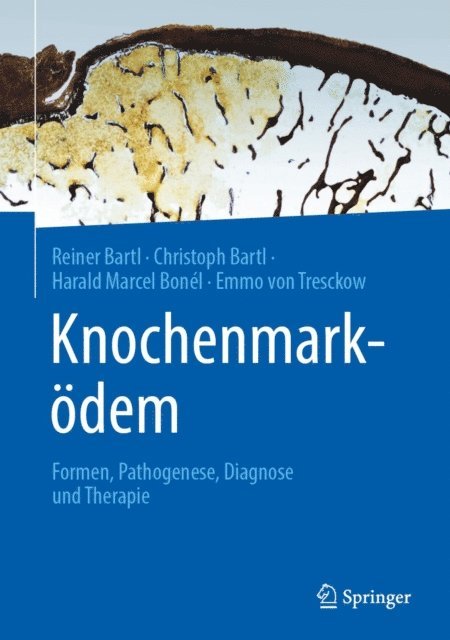 Emmo von Tresckow, Harald Marcel Bonel, Christoph Bartl, Reiner Bartl - Knochenmarködem, E-bok