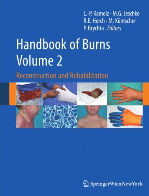 Pavel Brychta, Markus Kuntscher, Raymund E. Horch, Marc G. Jeschke, Lars-Peter Kamolz - Handbook of Burns Volume 2, E-bok