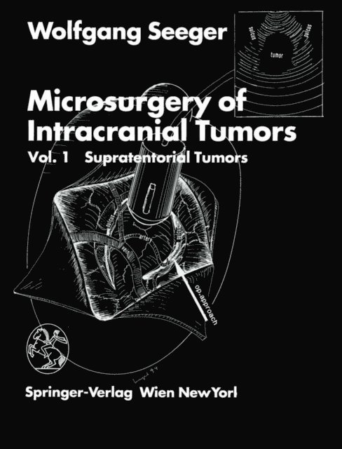 Wolfgang Seeger - Microsurgery of Intracranial Tumors, E-bok