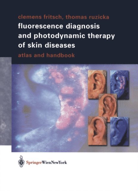 Thomas Ruzicka, Clemens Fritsch - Fluorescence Diagnosis and Photodynamic Therapy of Skin Diseases, E-bok