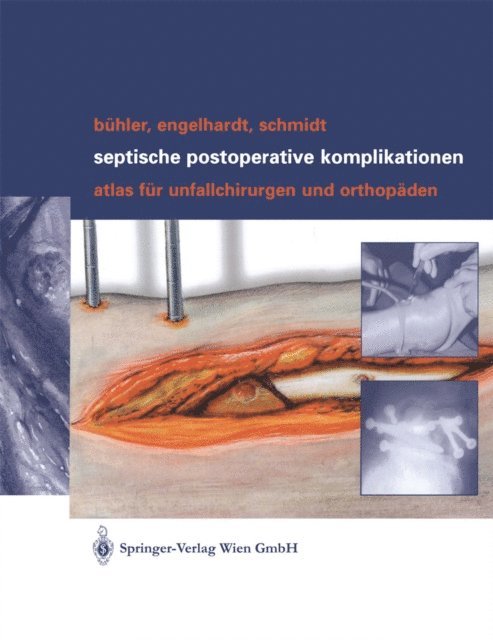 Hergo G.K. Schmidt, Martin Engelhardt, Matthias Buhler - Septische postoperative Komplikationen, E-bok