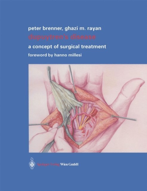 Ghazi M. Rayan, Peter Brenner - Dupuytren's Disease, E-bok