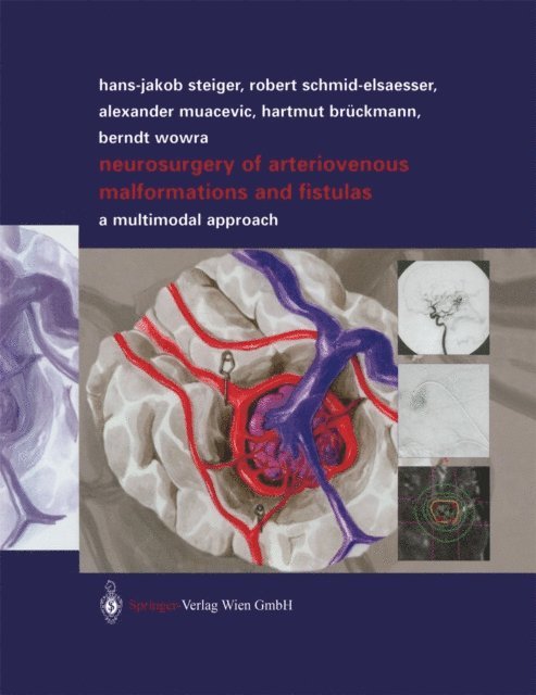 Berndt Wowra, Hartmut Bruckmann, Alexander Muacevic, Robert Schmid-Elsaesser - Neurosurgery of Arteriovenous Malformations and Fistulas, E-bok