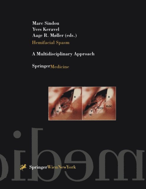 Aage R. Moller, Yves Keravel, Marc Sindou - Hemifacial Spasm, E-bok