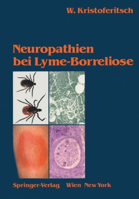 Wolfgang Kristoferitsch - Neuropathien bei Lyme-Borreliose, E-bok