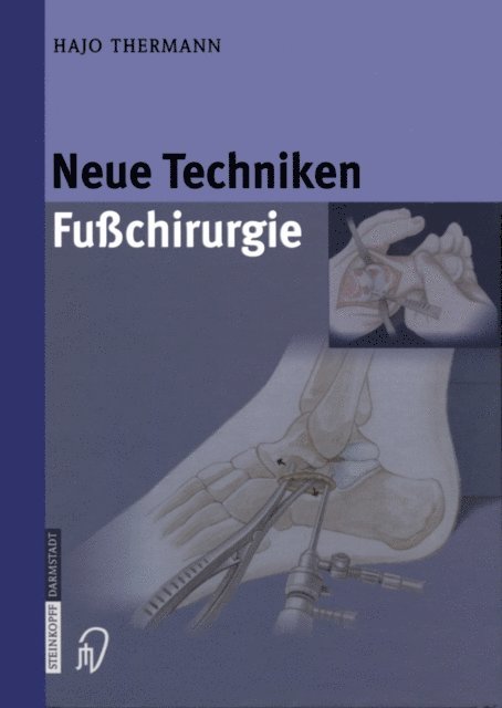 Hajo Thermann - Neue Techniken Fusschirurgie, E-bok