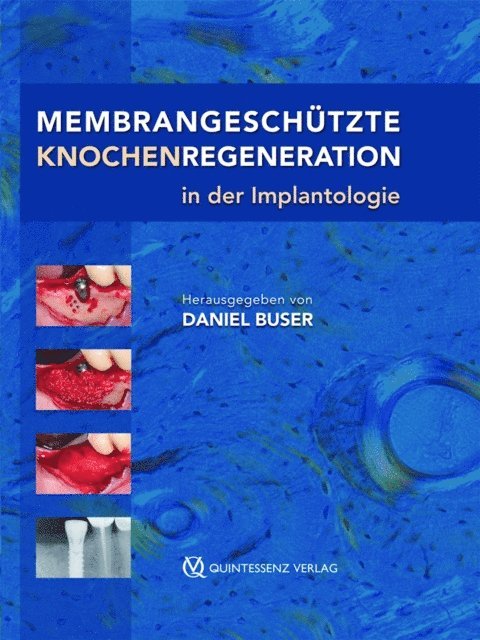 Daniel Buser - Membrangeschützte Knochenregeneration in der Implantologie, E-bok