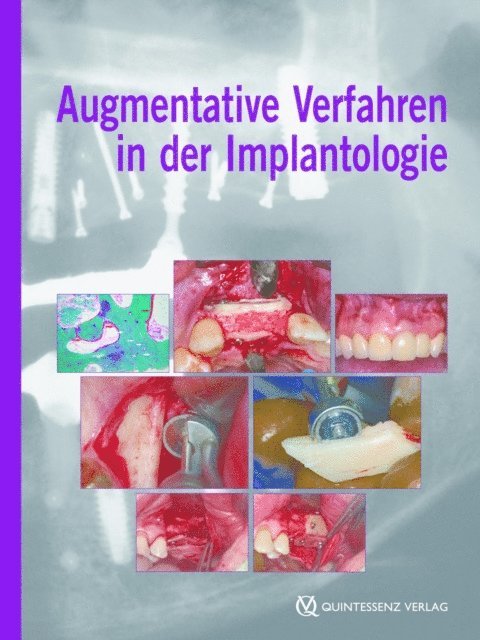 Fouad Khoury - Augmentative Verfahren in der Implantologie, E-bok