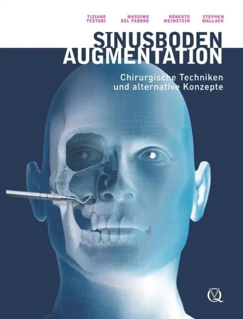 Stephan Wallace, Roberto Weinstein, Massimo del Fabbro, Tiziano Testori - Sinusbodenaugmentation, E-bok. Tillgänglighet: Lägg i varukorg