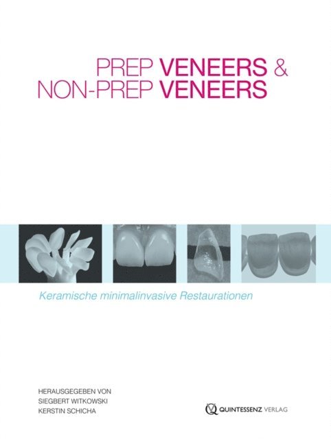 Kerstin Schicha, Siegbert Witkowski - Prep Veneers und Non-Prep Veneers, E-bok