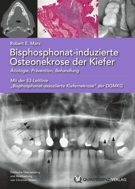 Robert E. Marx - Bisphosphonat-induzierte Osteonekrose der Kiefer, E-bok