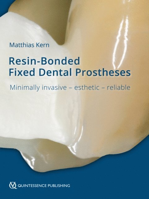 Matthias Kern - Resin-Bonded Fixed Dental Prostheses, E-bok