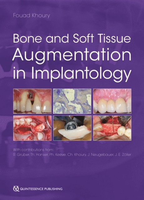 Fouad Khoury - Bone and Soft Tissue Augmentation in Implantology, E-bok