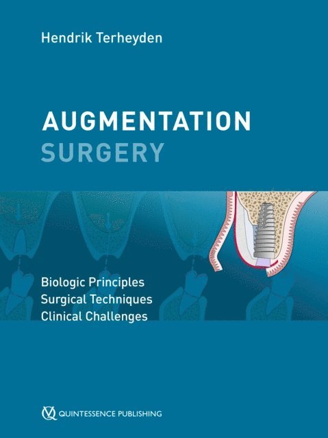 Hendrik Terheyden - Augmentation Surgery, E-bok