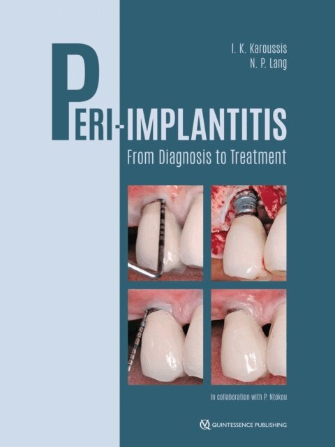 Niklaus P. Lang, Ioannis K. Karoussis - Peri-Implantitis, E-bok