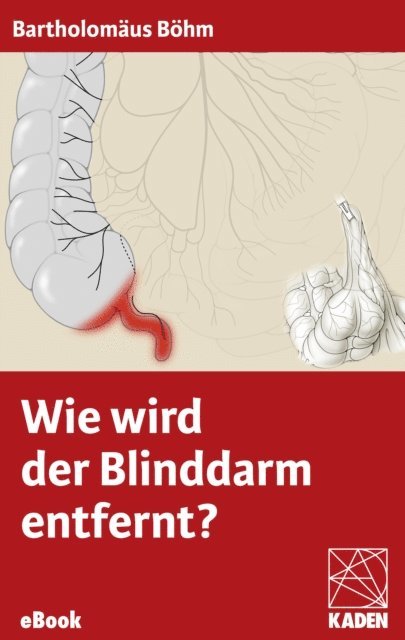 Bartholomaus Bohm - Wie wird der Blinddarm entfernt?, E-bok