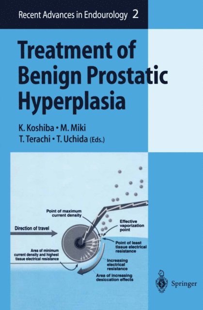 T. Uchida, T. Terachi, M. Miki, K. Koshiba - Treatment of Benign Prostatic Hyperplasia, E-bok