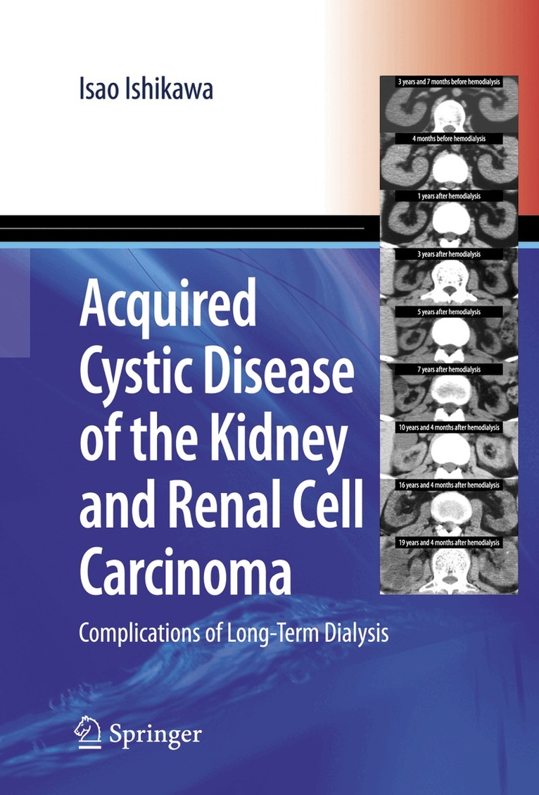 Isao Ishikawa - Acquired Cystic Disease of the Kidney and Renal Cell Carcinoma, Inbunden. Tillgänglighet: Lägg i varukorg